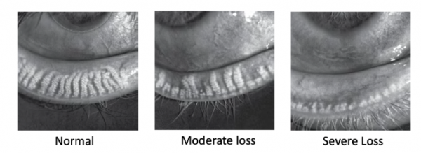 Lipiflow Dry Eye Treatment Delaware Eye Care Center 